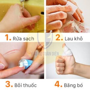 các bước xử ly khi bị đứt tay