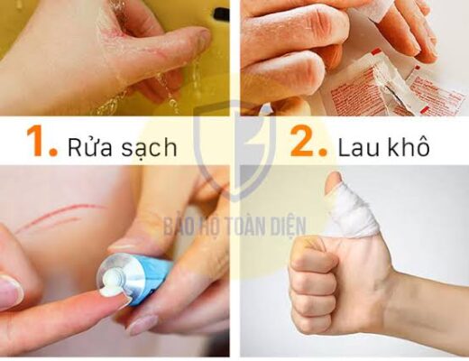 các bước xử ly khi bị đứt tay