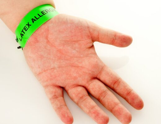 Latex Allergy Rash