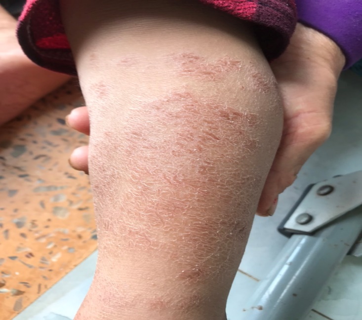 Phun thuốc sâu có thể gây dị ứng da