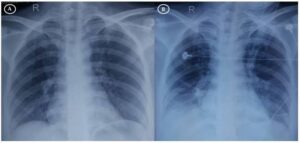 ảnh X-quang bệnh nhân tổn thương phổi do hít khói từ đám cháy