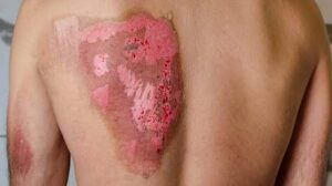 bỏng cấp độ 3