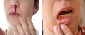 Sốt xuất huyết gây chảy máu mũi và chân răng